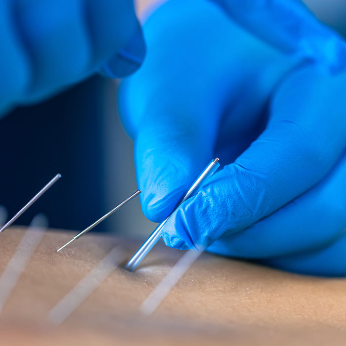 Dry Needling
